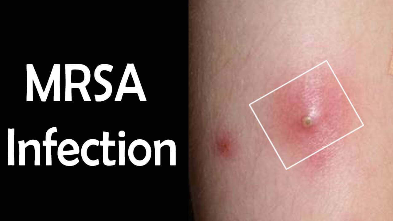 Хатигтай АНДУУРАГДСАН “MRSA” халдварын тохиолдол нэмэгджээ