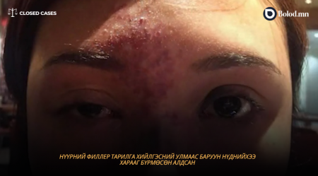 Closed Cases | Нүүрний филлер тарилга хийлгэсний улмаас баруун нүднийхээ харааг бүрмөсөн алдсан хэрэг