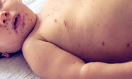 Хэнтий аймагт улаанбурхнаар гурван сартай хүүхэд энджээ